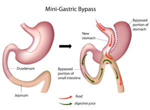 mini gastric bypass surgery for weight loss
