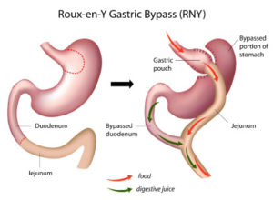 Gastric Bypass surgery