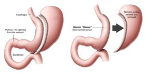 Sleeve Gastrectomy Bariatric Surgery for weight loss