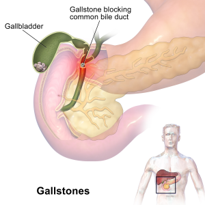 Gall Bladder Surgery for Stones