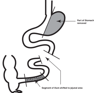 ileal interposition surgery for diabetes
