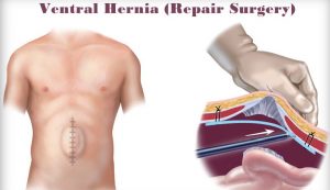 ventral hernia treatment 