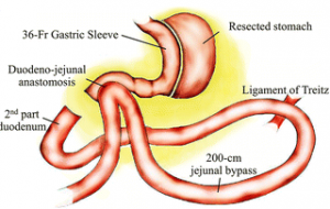 duodenojejunal bypass